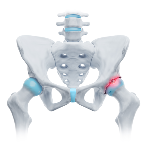 Bild Coxarthrose