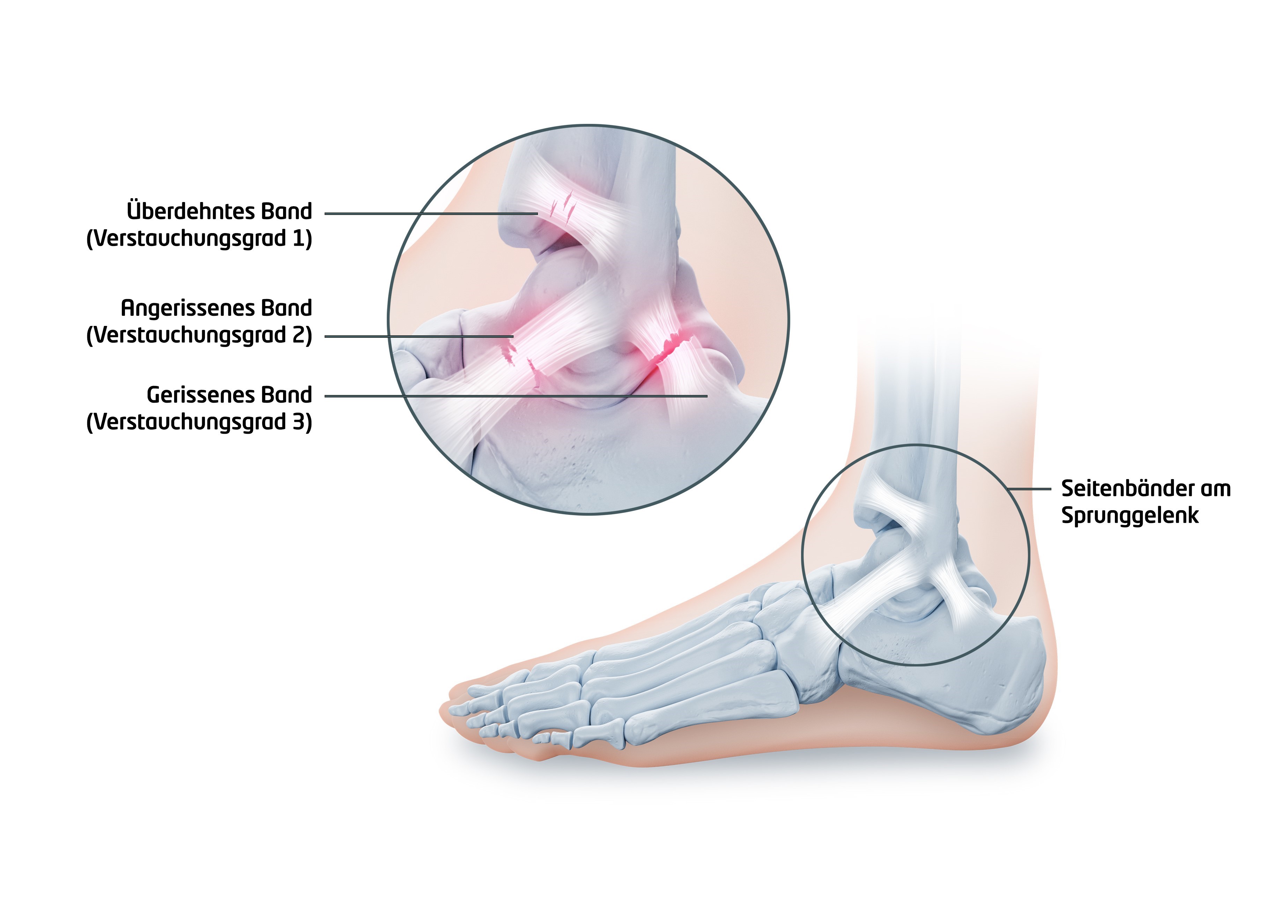 Ankle joint distortion