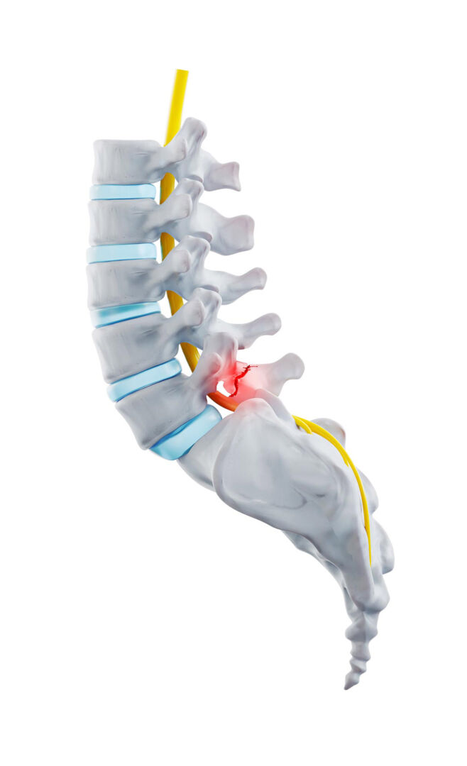 Schematische Darstellung einer Spondylolyse (Spaltbildung am Wirbelbogen durch einen Ermüdungsbruch) am 5. Lendenwirbel