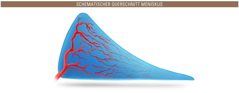 Meniskusverletzung