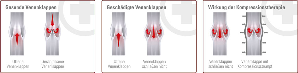 Venenklappen